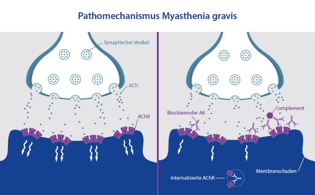 Grafik, welche die Störung der Rezeptoren für Acetylcholin (ACh) visualisiert, woraus Myasthenia gravis resultiert.